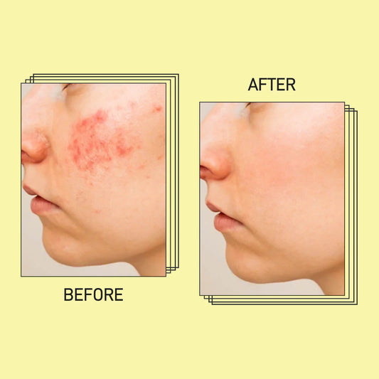 Acne Facewash (100ml)- 100% Organic