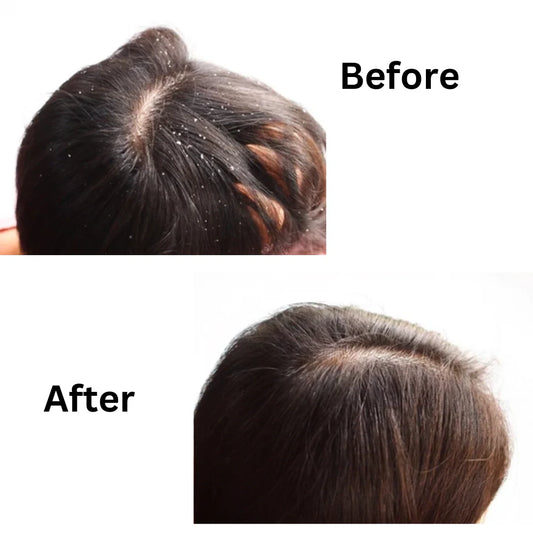Anti Dandruff Hair Oil – 100% Herbal